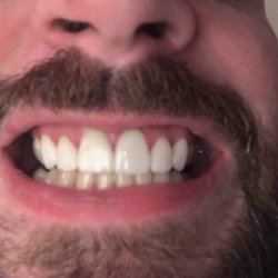 Brian L. Britton, DDS - After crowns and a lot of work!