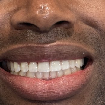 Dana Point Dental  - Teeth after veneers. - General Dentistry Near Me - Dana Point, California