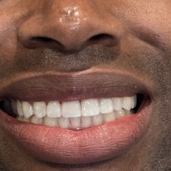Dana Point Dental  - Teeth after veneers.
