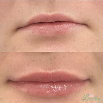 Laceleaf MedSpa - Medical Spas Near Me - Wesley Chapel, Florida Laceleaf MedSpa - Medical Spas Near Me - Wesley Chapel, Florida