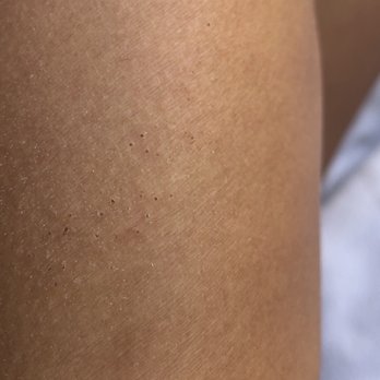 Irvine Spa - Result of body scrub 2 days later.. - Day Spas Near Me - Irvine, California Irvine Spa - Result of body scrub 2 days later.. - Day Spas Near Me - Irvine, California