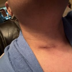 Yaghoobian Arash, MD - 5 days after surgery