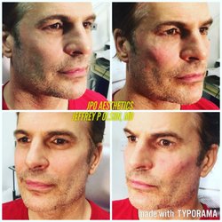 JPO Aesthetics/Dr. Jeffrey P Olson - Actor/artist Thom Bierdz. Facial sculpting