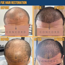 Concord Hair Restoration - Look at that coverage!!