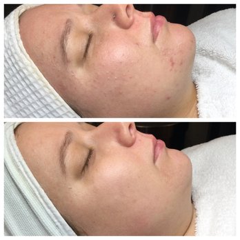 Luminous Skin - Four months of consistent home care and treatments - Skin Care Near Me - Florence, Kentucky Luminous Skin - Four months of consistent home care and treatments - Skin Care Near Me - Florence, Kentucky
