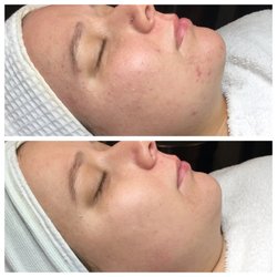Luminous Skin - Four months of consistent home care and treatments