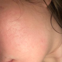 After 11 sessions 01/2022