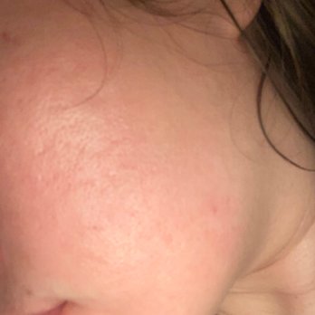 LaserAway - After 11 sessions 01/2022 - Medical Spas Near Me - Anaheim, California