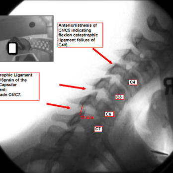 Digital Motion Xray - Auto "Accidents," Whiplash Injuries cause catastrophic failure of Facet Capsule Ligaments. Digital Motion X-ray demonstrates the severity. - Diagnostic Imaging Near Me - Ogden, Utah