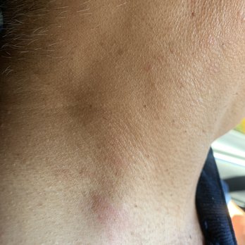 Jin's Massage - Scratch from massage. - Massage Near Me - Los Angeles, California