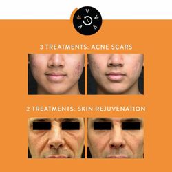 Skinetic Aesthetics - Achieve results with Viora IPL and Laser Skin Resurfacing
