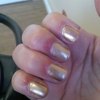 Love Nails - Infection I recieved from Love Nails in Chino, CA. (01.28.16) - Nail Technicians Near Me - Chino, California Love Nails - Infection I recieved from Love Nails in Chino, CA. (01.28.16) - Nail Technicians Near Me - Chino, California