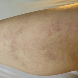 Hawaii Vein Institute - Bad result.