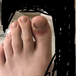 Infected toe following pedicure