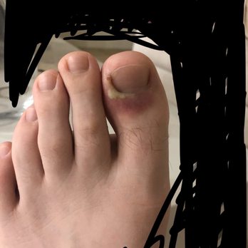 Betty Nails - Infected toe following pedicure - Nail Salons Near Me - Lafayette, Louisiana