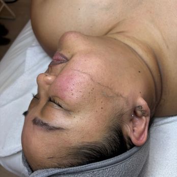 Honest Skin - Dermaplaning in process with Abri - Skin Care Near Me - San Diego, California Honest Skin - Dermaplaning in process with Abri - Skin Care Near Me - San Diego, California