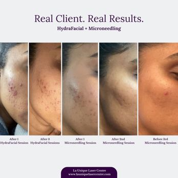 La Unique Laser Centre - Book an appointment at our Mississauga or Brampton clinic for a free consultation! 905-799-2354 www.launiquelasercentre.com - Laser Hair Removal Near Me - Brampton, Ontario La Unique Laser Centre - Book an appointment at our Mississauga or Brampton clinic for a free consultation! 905-799-2354 www.launiquelasercentre.com - Laser Hair Removal Near Me - Brampton, Ontario