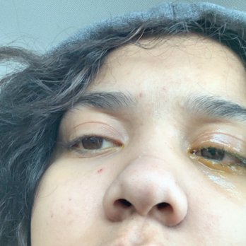 Tip Top Nails - This was my eye after I left the ER - Nail Salons Near Me - Gallup, New Mexico Tip Top Nails - This was my eye after I left the ER - Nail Salons Near Me - Gallup, New Mexico