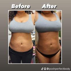 Cavitation treatment