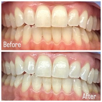 Opalite Collective - Teeth Whitening Near Me Opalite Collective - Teeth Whitening Near Me