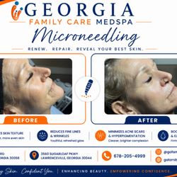 Georgia Family Care - Reveal smoother, healthier skin with microneedling in Lithonia. Reduce fine lines, improve texture, and refresh your glow.