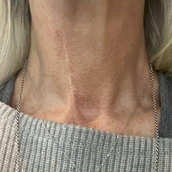 Rodnick Chiropractic - Cervical spine fusion.  (scar) - Chiropractors Near Me - Midland, Michigan