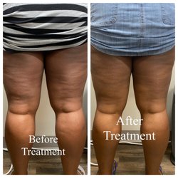 Bella Body Spa - Skin Tightening treatment. Diminishes cellulite, and tightens the skin.