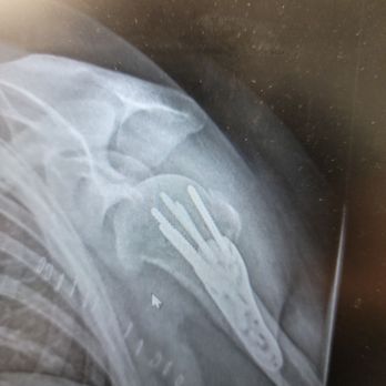 David Privitera, MD - Fixed left humorous immediately post surgery - Sports Medicine Near Me - Warsaw, New York David Privitera, MD - Fixed left humorous immediately post surgery - Sports Medicine Near Me - Warsaw, New York
