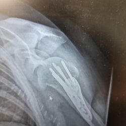 David Privitera, MD - Fixed left humorous immediately post surgery