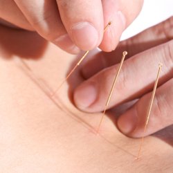 Physician Acupuncture - Painless and relaxing procedure brings relief from a wide range of pain issues.