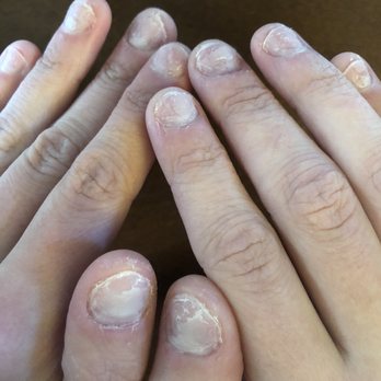 Best Nail Spa - Botched acrylic removal! Clearly uneven spots where acrylic remains & what's left of my real nails are in really bad shape - Nail Salons Near Me - South Bend, Indiana Best Nail Spa - Botched acrylic removal! Clearly uneven spots where acrylic remains & what's left of my real nails are in really bad shape - Nail Salons Near Me - South Bend, Indiana