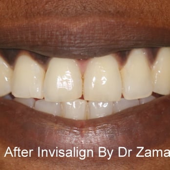 Dent-All By Dr Z - After Invisalign - Cosmetic Dentists Near Me - Irvine, California