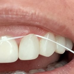 Steven P Marsh, DDS - Floss behind the bonding!