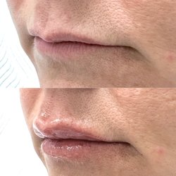 Lavish Beauty RN - Before and after of lip filler