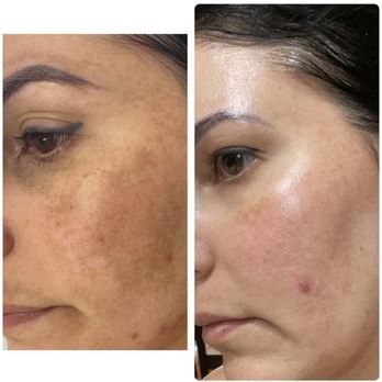 Dee's Laser & Medspa - Skin pigmentation treatment - melasma - Medical Spas Near Me - Cape Coral, Florida Dee's Laser & Medspa - Skin pigmentation treatment - melasma - Medical Spas Near Me - Cape Coral, Florida