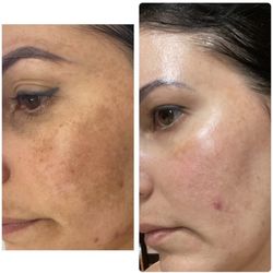 Dee's Laser & Medspa - Skin pigmentation treatment - melasma
