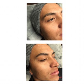 Ec Aesthetics - Skin Tightening Treatments. Helps with saggy skin, fine lines/ wrinkles, & with texture . - Makeup Artists Near Me Ec Aesthetics - Skin Tightening Treatments. Helps with saggy skin, fine lines/ wrinkles, & with texture . - Makeup Artists Near Me