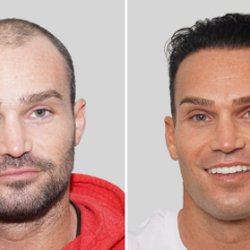 Advanced Hair Restoration