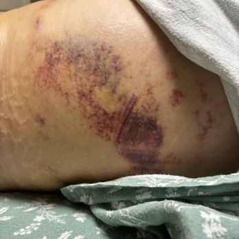 Smart Plastic Surgery Miami - Bruising on hips starting to fade - Cosmetic Surgeons Near Me - Miami, Florida Smart Plastic Surgery Miami - Bruising on hips starting to fade - Cosmetic Surgeons Near Me - Miami, Florida