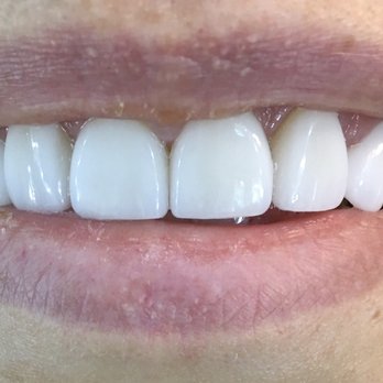 Nicole Carnicella DMD MAGD - Permanent veneers front - General Dentistry Near Me - Bellefonte, Pennsylvania Nicole Carnicella DMD MAGD - Permanent veneers front - General Dentistry Near Me - Bellefonte, Pennsylvania