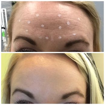 LaserAway - Before and after getting Botox on my forehead. The after picture was taken the next morning. Great job Laser Away! - Medical Spas Near Me - Dublin, California LaserAway - Before and after getting Botox on my forehead. The after picture was taken the next morning. Great job Laser Away! - Medical Spas Near Me - Dublin, California