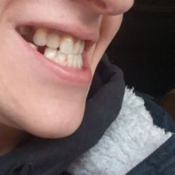 Steel City Dental - Clear shot of shaved front tooth at bottom corner diagonally performed by assistant Kenya without alerting me