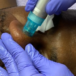 Brenda's Beautiful Skin Studio - Hydrodermabrasion extractions
