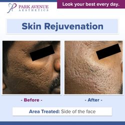 Park Avenue Aesthetics - Kin rejuvenation with microneedling - visible improvement in pock marks after treatment.