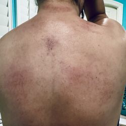 37 Body Foot Spa - Bruises left after a full body massage.