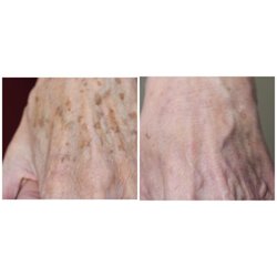 Silhouette Cosmetic Laser Clinic - BBL post two treatments on hands for pigmentation.