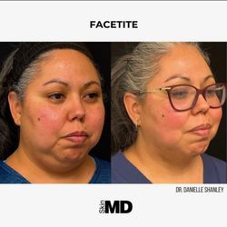 Skin MD - FaceTite is a minimally invasive cosmetic procedure that tightens skin & melt fat, offering a non-surgical alternative to a facelift.
