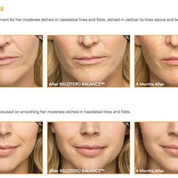 Lucali Aesthetic Medicine - Temecula Botox Wrinkle Removal Face Neck Tightening Fillers Ultherapy