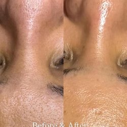 Mimi's Spa - Befor and after a deep cleaning facial & hydro mask it's most popular