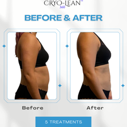 Radiance and Ice - Cryo-Lean, Fat Freezing, Body Contouring, Muscle Toning, Skin Tightening
